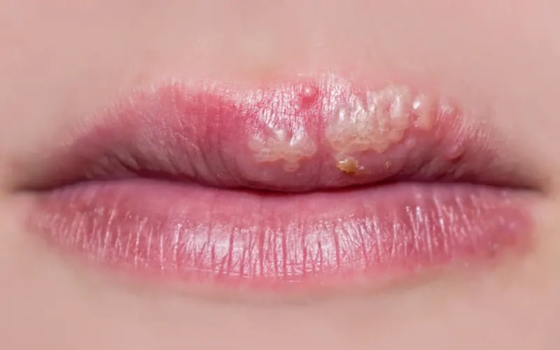 10 مورد از شایع ترین مشکلات پوستی و پیشگیری یا درمان آنها 5 ااااااااا