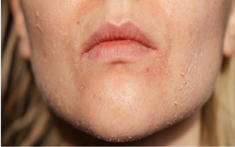 10 مورد از شایع ترین مشکلات پوستی و پیشگیری یا درمان آنها 7 ااااااااااا