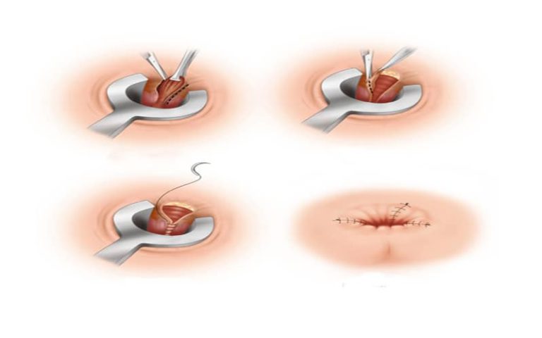 باز شدن بخیه هموروئید