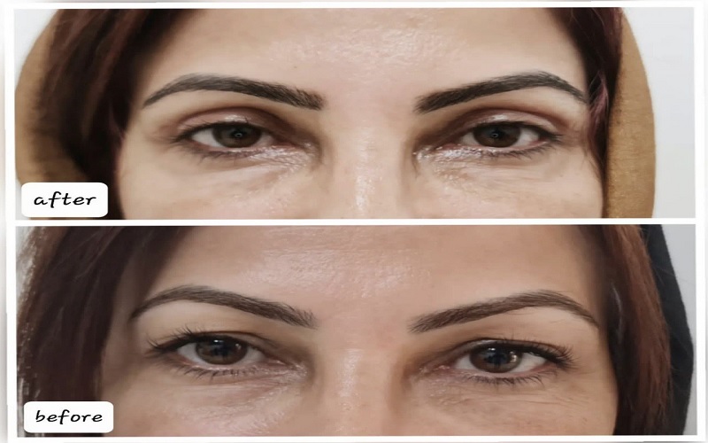 بلفاروپلاستی با لیزر: راهنمای جامع کاربردها، مزایا و نکات مراقبتی 3 آیا بلفاروپلاستی با لیزر جای زخم بهجا میگذارد؟