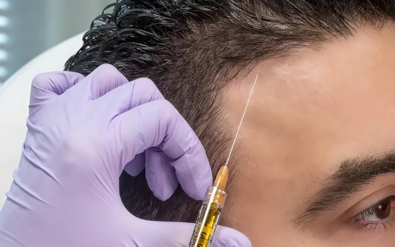 مزوتراپی مو برای چه کسانی مناسب است؟ + معرفی فواید و عوارض 3 فواید مزوتراپی مو