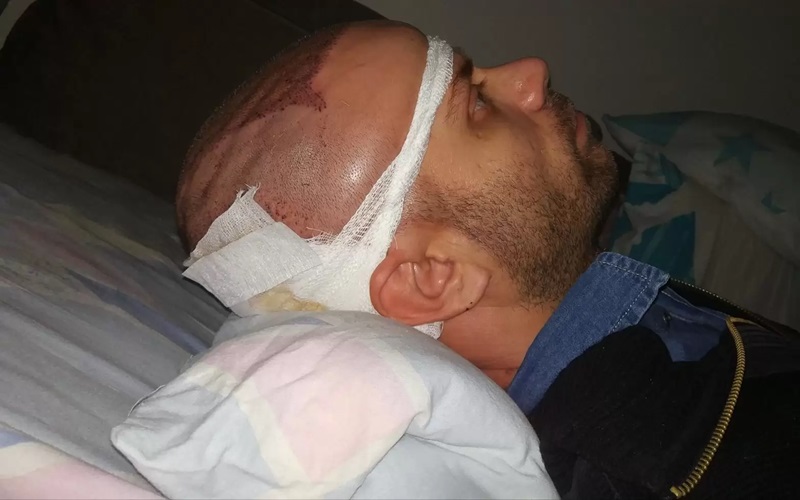 اهمیت نحوه خوابیدن بعد از کاشت مو 3 مراقبتهای تکمیلی همراه با نحوه خوابیدن بعد از کاشت مو