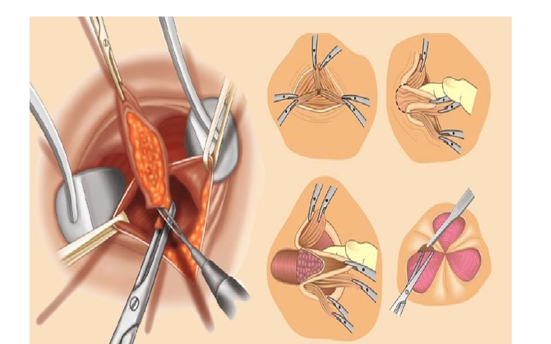 باز شدن بخیه هموروئید: علائم، دلایل و بهترین راهکارهای درمانی 1 علائم اصلی باز شدن بخیه هموروئید چیست؟ چگونه تشخیص دهیم؟