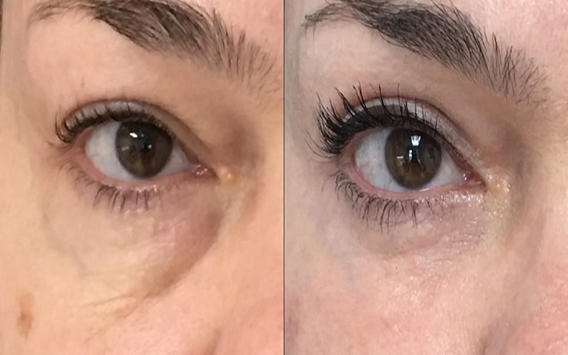 کرم ترمیم کننده بعد از بلفاروپلاستی: راهنمای کامل از اهمیت تا معرفی بهترینها 2 بهترین زمان برای شروع و نحوه استفاده از کرم ترمیم کننده