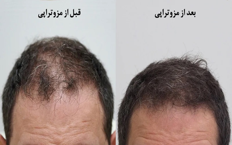 روش های جایگزین کاشت مو؛ راهکارهایی برای درمان ریزش مو بدون جراحی 3 مزوتراپی مو