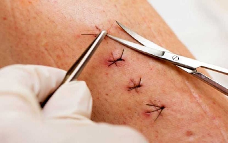 باز شدن بخیه هموروئید: علائم، دلایل و بهترین راهکارهای درمانی 3 پیشگیری از باز شدن بخیه هموروئید: نکات کلیدی برای بهبودی کامل