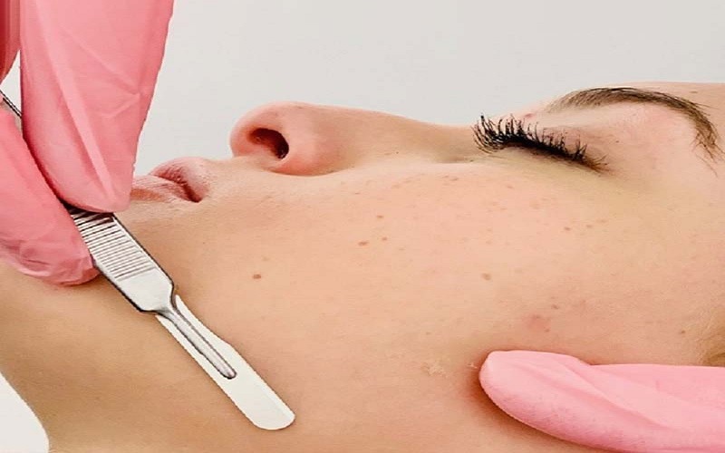 راهنمای کامل درماپلنینگ: مزایا، مراحل انجام و مراقبتهای بعد از آن 1 درماپلنینگ چیست؟