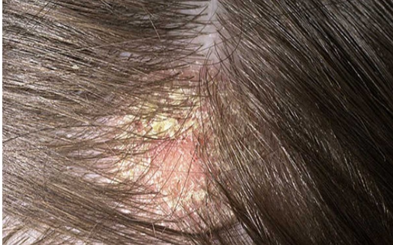 کاشت مو برای بیماران پسوریازیس پوست سر 1 پسوریازیس پوست سر