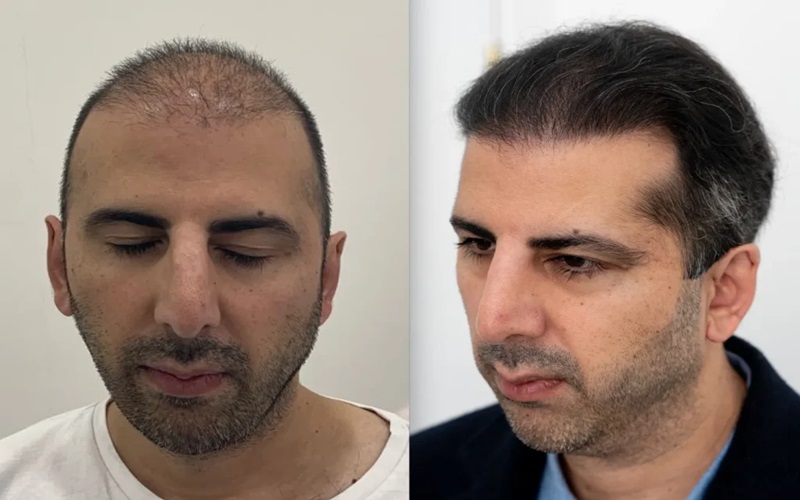 کاشت مو با الیاف نانو چیست و چگونه انجام میگیرد؟ 2 مزایای کاشت مو با الیاف نانو