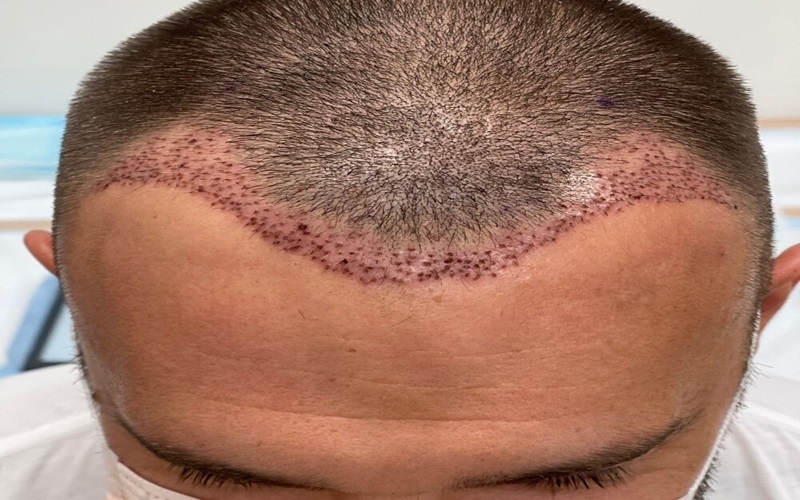 کبودی و ورم چشم بعد از کاشت مو: راهنمای جامع پیشگیری و درمان 2 داروهای تجویزی