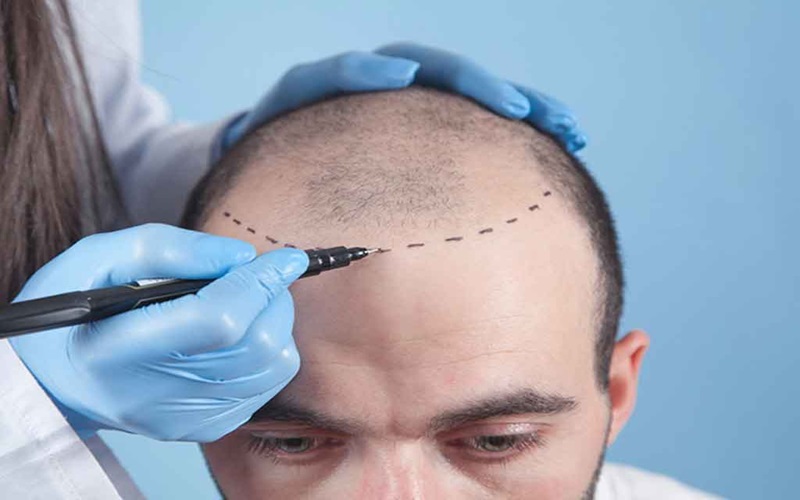 کاشت مو با الیاف نانو چیست و چگونه انجام میگیرد؟ 1 کاشت مو با الیاف نانو چیست؟