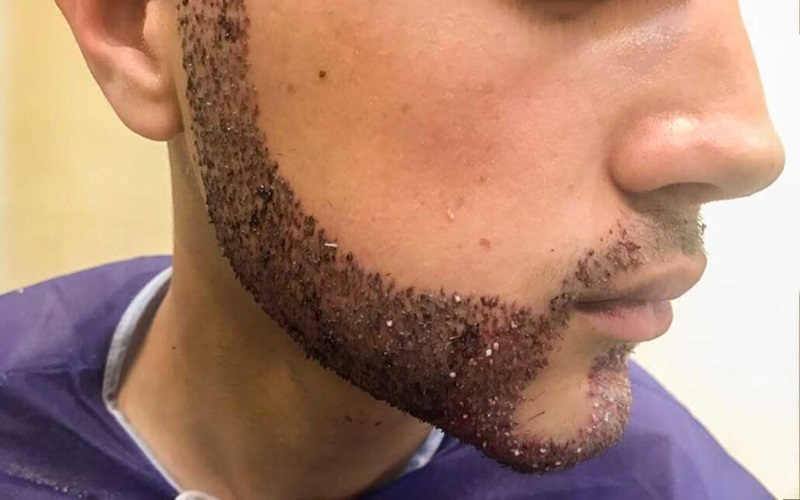 سوالات رایج در خصوص کاشت ریش: راهنمای کامل برای آقایان 2 نتایج کاشت ریش دائمی است؟