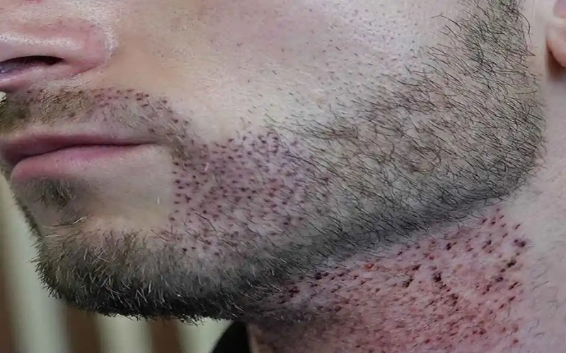 سوالات رایج در خصوص کاشت ریش: راهنمای کامل برای آقایان 3 هزینه و انتخاب کلینیک مناسب