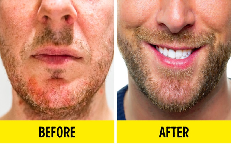 روشهای پرپشت شدن ریش 2 مراقبتهای پوستی