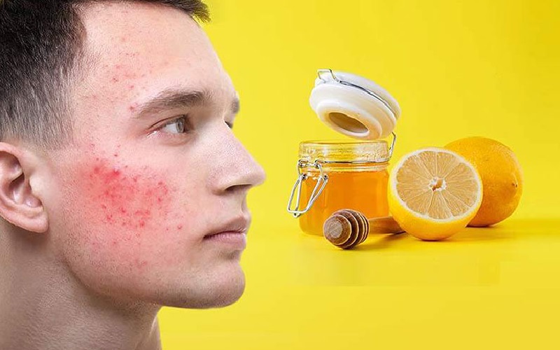 درمان خانگی لک صورت | از بین بردن لک صورت با 10 روش خانگی 1 ماسک عسل و لیمو