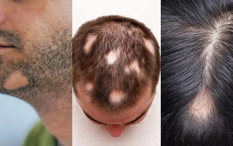 ریزش مو سکهای (علت و درمان) 1 علت ریزش مو سکهای