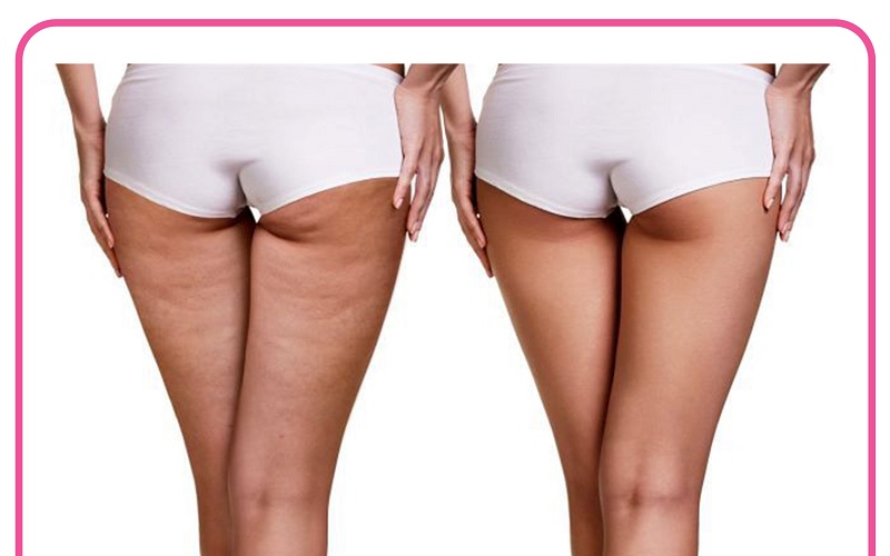 11 روش درمان سلولیت خانگی و کلینیکی 2 لیزر درمانی