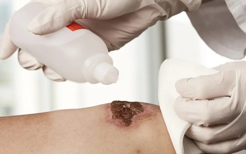 دبریدمان زخم چیست؟ آیا دردناک است؟ | راهنمای کامل انواع و روشها 3 دبریدمان اتولیتیک: روشی بدون درد و خونریزی