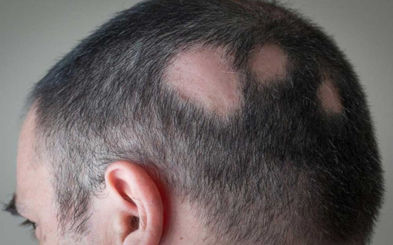 ریزش مو سکهای (علت و درمان) 2 انواع ریزش مو سکهای