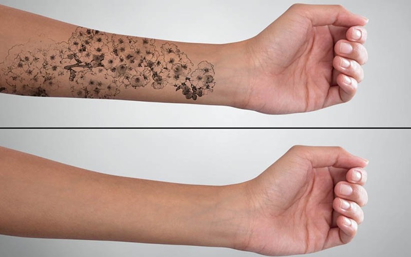 آموزش پاک کردن تتو در اصفهان: راهنمای کامل برای حذف تتو به صورت ایمن 2 روشهای خانگی و مراقبتهای اولیه