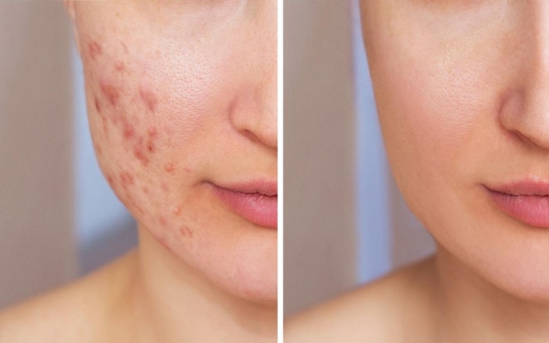 درمان اسکار جوش با طب سنتی: راهکارهای طبیعی و گیاهی برای پوستی صاف 1 اسکار جوش چیست