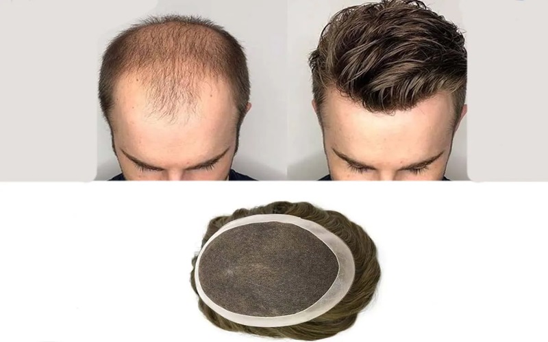 دلایل ترجیح کاشت مو بر پروتز مو 1 طبیعی بودن ظاهر