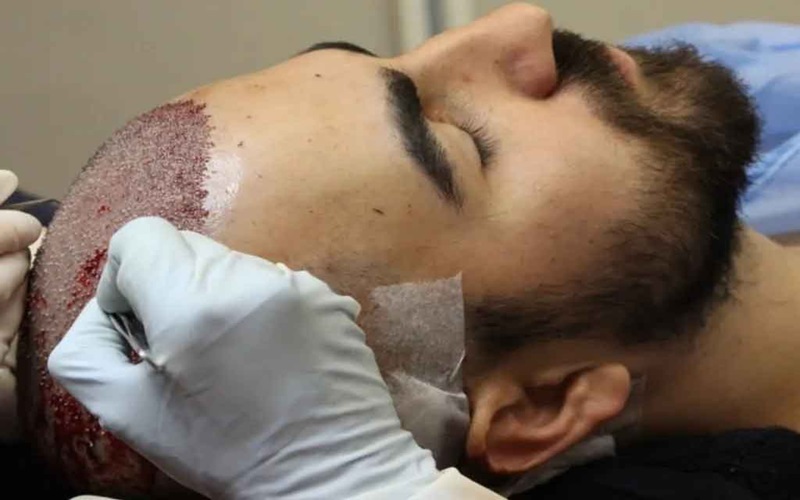 دلیل بیحسی کف سر پس از کاشت مو چیست؟ بررسی علل، مدت زمان و درمان 1 بی حسی کف سر پس از کاشت مو چیست؟