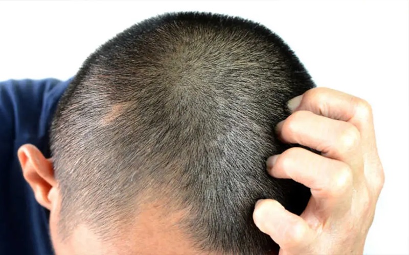 ممنوعیات پس از کاشت مو: نکات حیاتی برای بهبودی سریع و نتیجه طبیعی 2 خارش، لمس و فشار دادن ناحیه کاشت