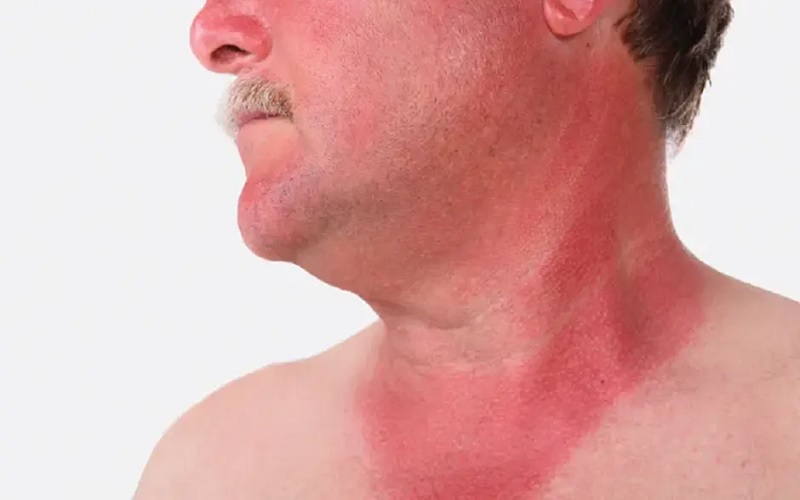 بهترین راههای درمان خانگی سوختگی با آب جوش: تسکین فوری و التیام سریع 2 سوختگی درجه یک: علائم و ویژگیها