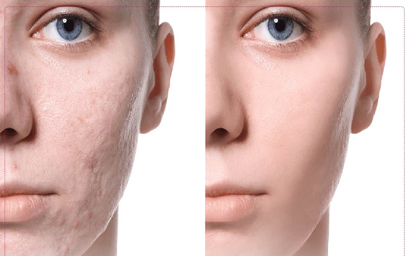 درمان اسکار جوش با طب سنتی: راهکارهای طبیعی و گیاهی برای پوستی صاف 5 مدت زمان لازم برای بهبود اسکار جوش با استفاده از روشهای طب سنتی