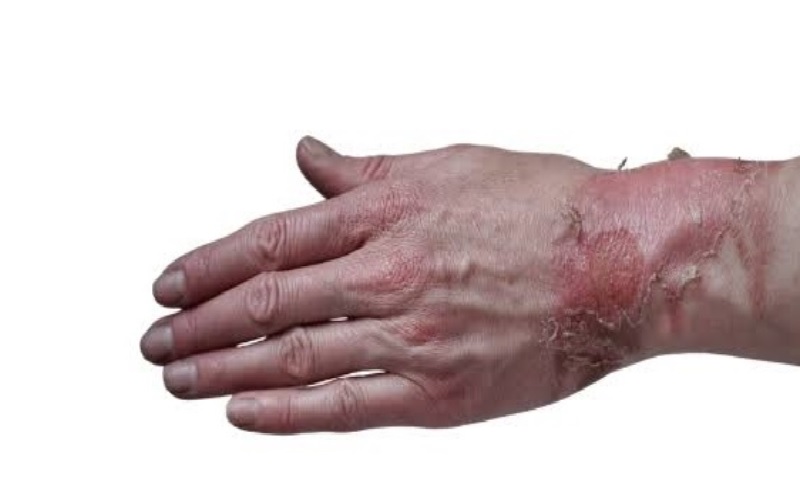 بهترین راههای درمان خانگی سوختگی با آب جوش: تسکین فوری و التیام سریع 4 ج 7