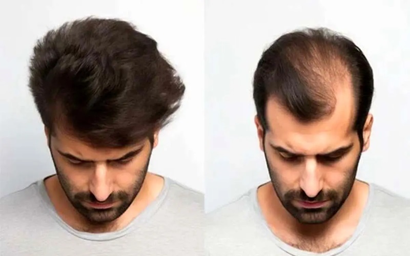 دلایل ترجیح کاشت مو بر پروتز مو 2 راحتی در نگهداری