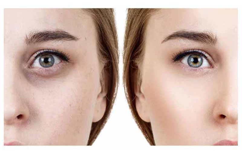 ۶ روش درمان خانگی پف زیر چشم؛ ساده، مؤثر و کاربردی 2 استفاده از روغنهای گیاهی