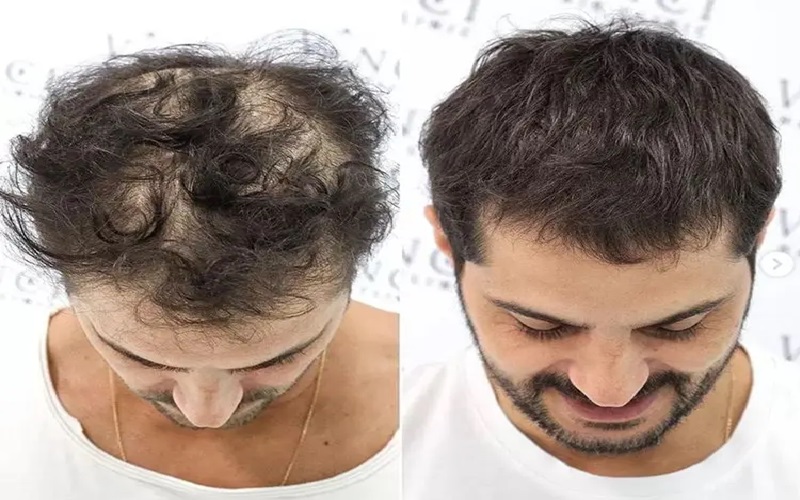 علت ریزش مو در مردان | بررسی دلایل و راههای پیشگیری 3 داروها و درمانهای خاص