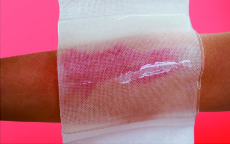 انواع پانسمان سوختگی: راهنمای جامع انتخاب بهترین پانسمان برای هر نوع سوختگی 3 انواع تخصصی پانسمانهای مدرن سوختگی و موارد کاربرد هر کدام