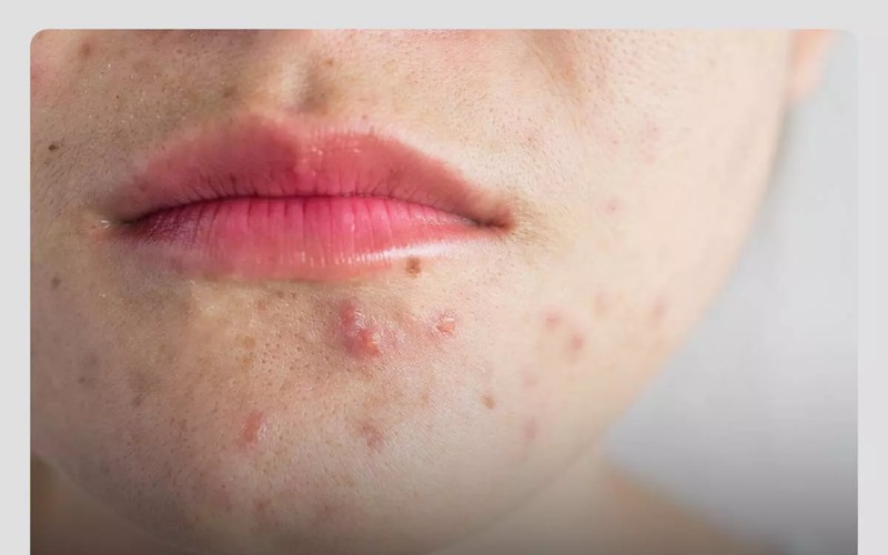 موی زیر پوستی و راهکارهای ساده برای پیشگیری و درمان آن 1 ججججججج