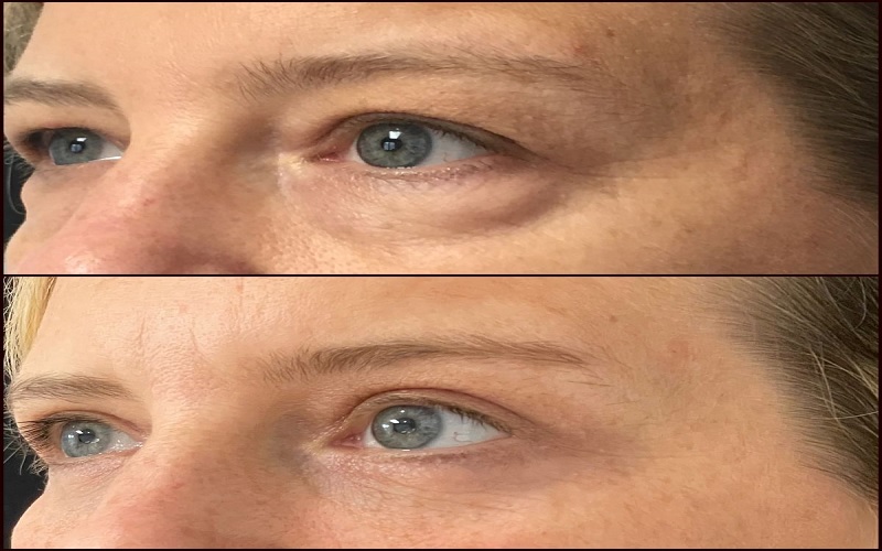 12 مزایای بلفاروپلاستی پلک بالا: جوانی و بینایی بهتر 3 ح 3