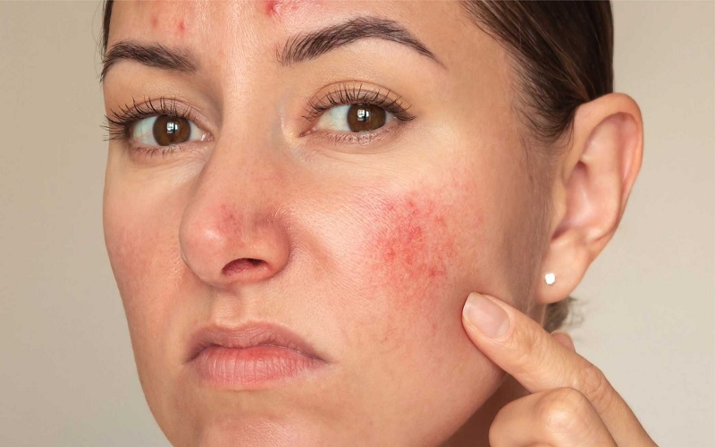 10 مورد از شایع ترین مشکلات پوستی و پیشگیری یا درمان آنها 2 اگزما (التهاب و خشکی پوست)