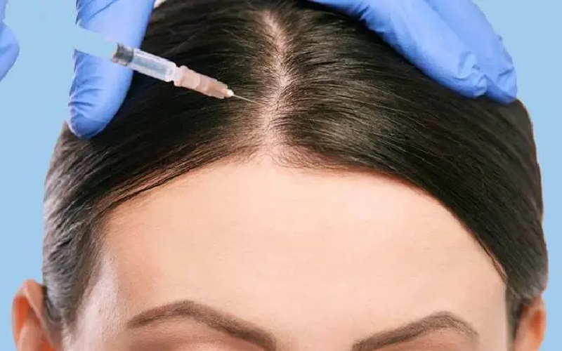 مزوتراپی مو برای چه کسانی مناسب است؟ + معرفی فواید و عوارض 1 مزوتراپی مو چیست؟