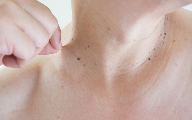 10 مورد از شایع ترین مشکلات پوستی و پیشگیری یا درمان آنها 4 زگیل