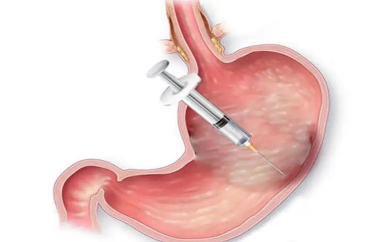 بوتاکس معده چیست؟ راهنمای کامل برای کاهش وزن 2 مزایای بوتاکس معده