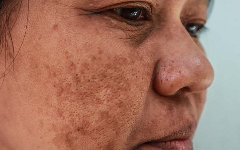 10 مورد از شایع ترین مشکلات پوستی و پیشگیری یا درمان آنها 6 لکهها و تیرگیهای پوست