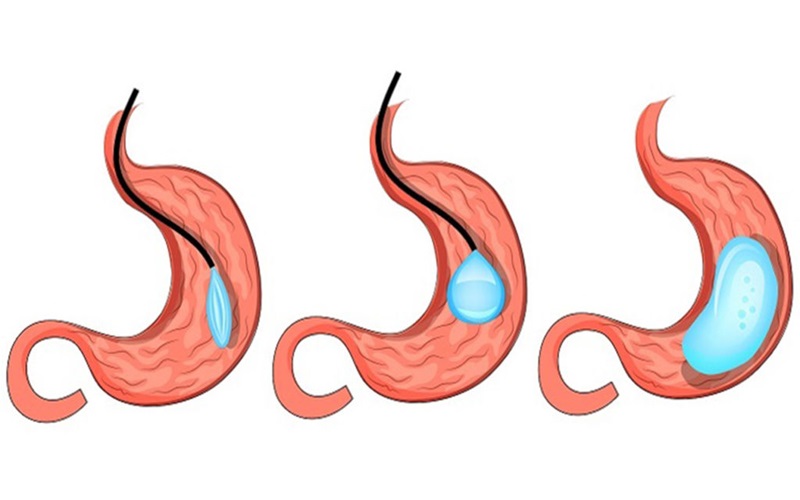 بوتاکس معده چیست؟ راهنمای کامل برای کاهش وزن 3 کاندیدای مناسب برای بوتاکس معده
