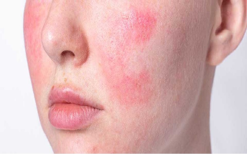 10 مورد از شایع ترین مشکلات پوستی و پیشگیری یا درمان آنها 8 خخخخخ 2