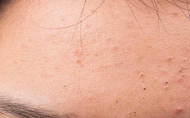 10 مورد از شایع ترین مشکلات پوستی و پیشگیری یا درمان آنها 10 خخخخخخخ