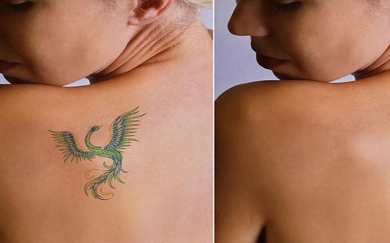 انواع روش های پاک کردن تتو | راهنمای جامع برای انتخاب بهترین گزینه 2 سایر روشهای نوین