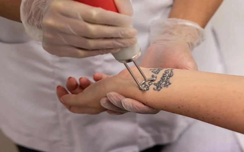 انواع روش های پاک کردن تتو | راهنمای جامع برای انتخاب بهترین گزینه 1 لیزردرمانی