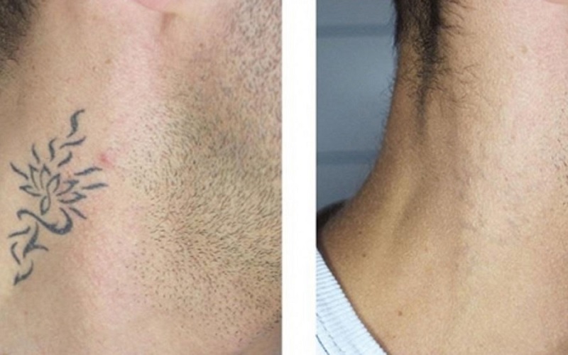 انواع روش های پاک کردن تتو | راهنمای جامع برای انتخاب بهترین گزینه 4 مراقبتهای قبل و بعد از پاک کردن تتو