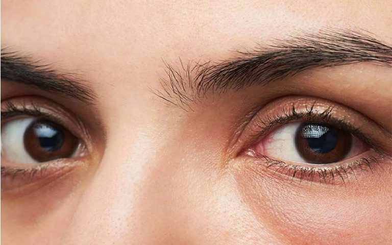 پف و تیرگی زیر چشم