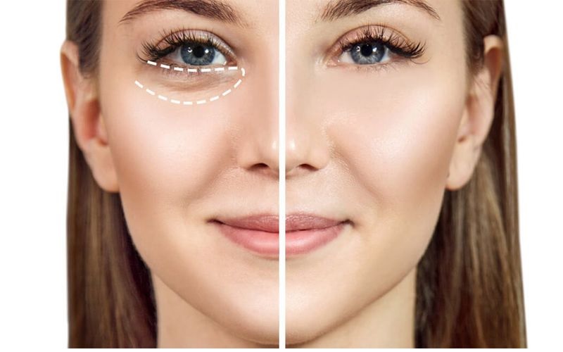 پف و تیرگی زیر چشم: راهنمای جامع تشخیص، علت و درمان 1 پف زیر چشم و تیرگی زیر چشم: تفاوت و تعریف دقیق